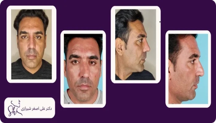 نمونه عمل بینی طبیعی - دکتر علی اصغر شیرازی