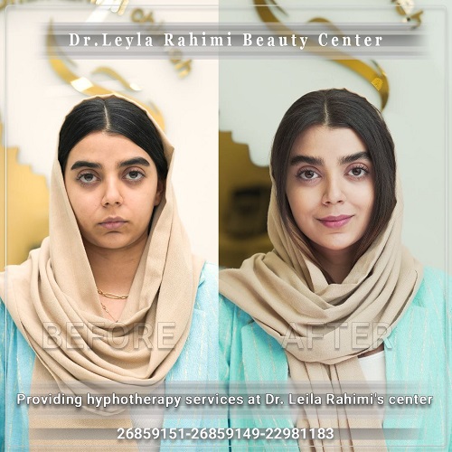 هایفو چگونه انجام می‌شود؟