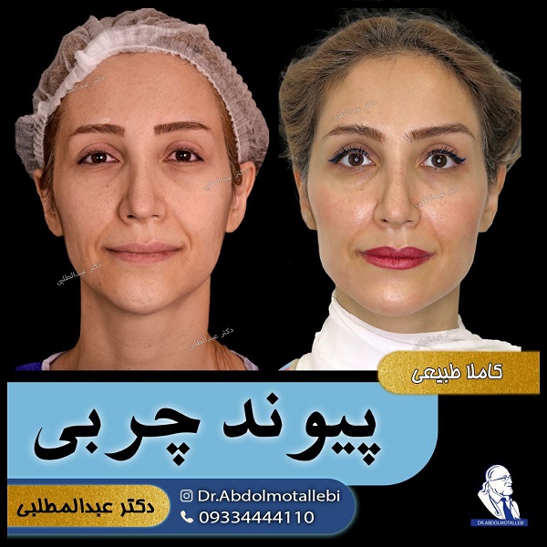 بهترین دکتر تزریق چربی در تهران چه ویژگی‌هایی دارد؟