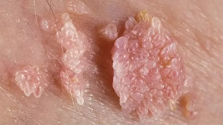 زگیل تناسلی(ویروسhpv) چیست؟