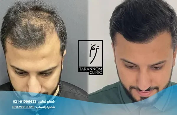 hair-transplant-portfolio-6