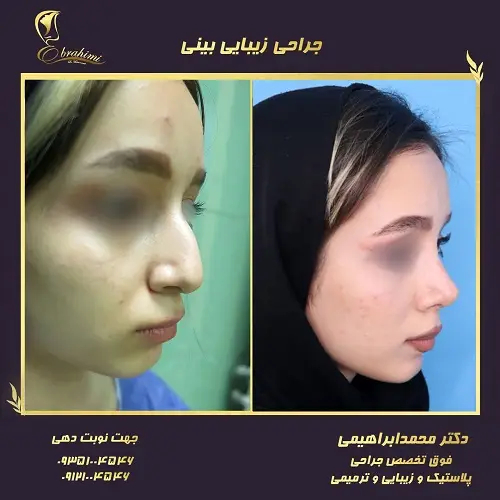 زمان مناسب برای ترمیم بینی خوکی بعد از عمل