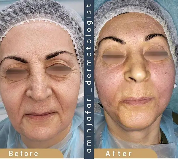 لیفتینگ صورت به روش مزوژل