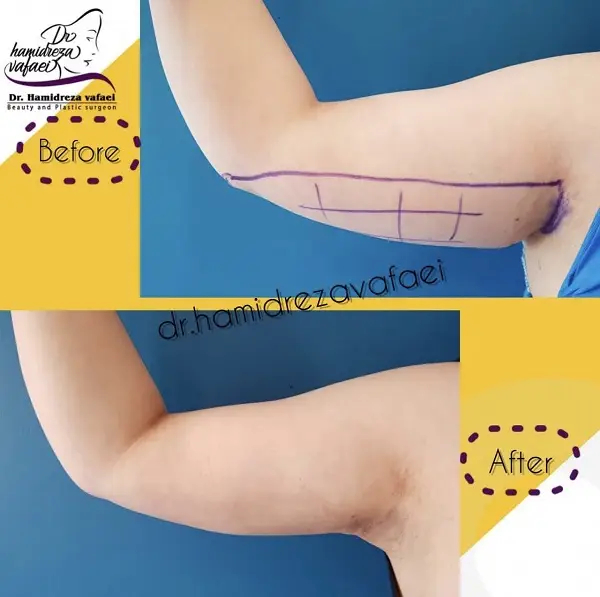 لاغری با پیکرتراشی؛ آیا این روند مشکل زا است؟ 