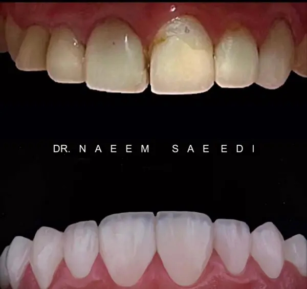 هزینه انواع لمینت دندان در تهران
