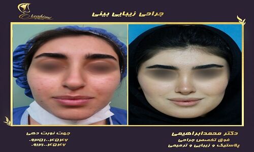 عمل بینی سربالا؛ زیبایی یا ریسک فرم غیرطبیعی؟ بررسی دقیق عمل ترمیم بینی خوکی