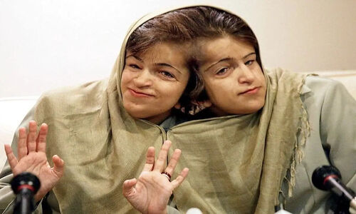 تصویری نایاب از کودکی لاله و لادن؛ دوقلوهای به هم چسبیده دهه 50 که قلب‌ها را لرزاندند