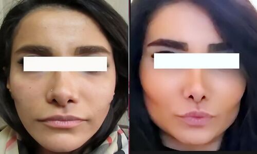 زاویه سازی فک؛ راهی نوین برای زیبایی بی‌نقص یا ریسک‌های پنهان؟