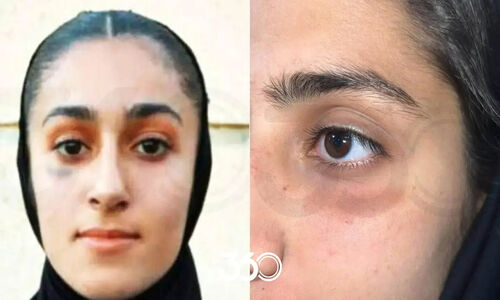 دو ستاره پرسپولیس زنان درگیر جنجالی بی‌سابقه؛ چشم کبود و انگشت شکسته در دل رقابت‌ها!